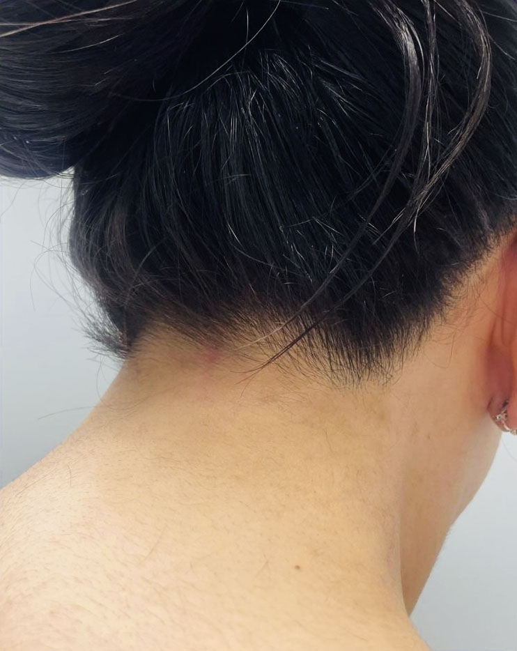 After Laser hair removal