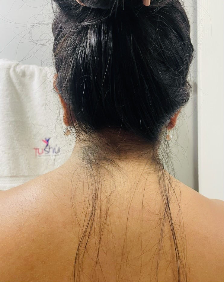 Before Laser hair removal